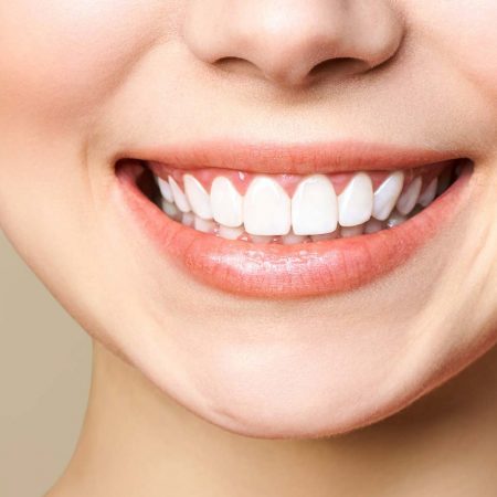 clareamento dental 2