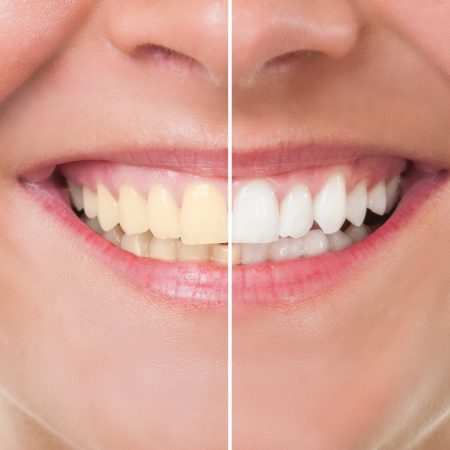 tipos-de-clareamento-dental